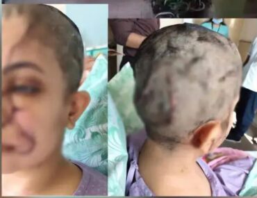 Woman Suffers Severe Injuries in Dog Attack at HSR Layout; Owner Booked Woman Suffers Severe Injuries in Dog Attack at HSR Layout; Owner Booked