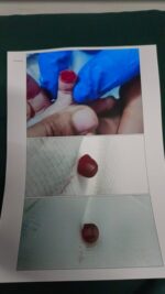 Bengaluru Baby Finger Severed in Hospital:FIR Filed Against Hospital Management,Doctor and Nurse for Alleged Negligence Bengaluru Baby Finger Severed in Hospital:FIR Filed Against Hospital Management,Doctor and Nurse for Alleged Negligence