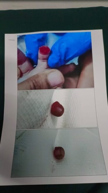 Bengaluru Baby Finger Severed in Hospital:FIR Filed Against Hospital Management,Doctor and Nurse for Alleged Negligence Bengaluru Baby Finger Severed in Hospital:FIR Filed Against Hospital Management,Doctor and Nurse for Alleged Negligence